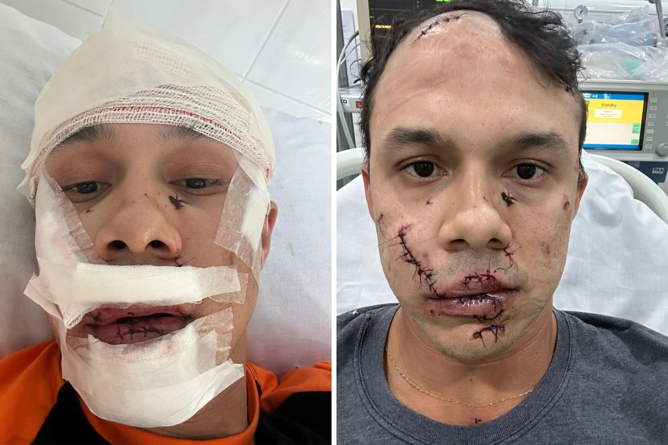Suspeito de agredir personal no rosto com copo de vidro em bar é identificado no DF; vítima precisou levar 45 pontos